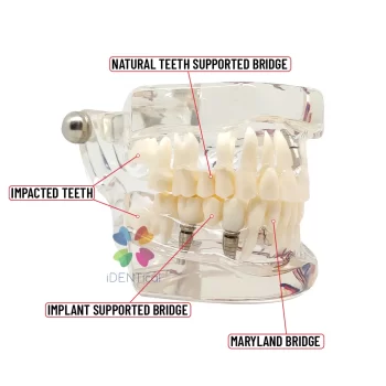DD+ Education - Jaw Set With Implant - Image 5