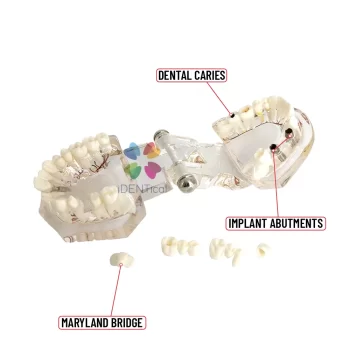 DD+ Education - Jaw Set With Implant - Image 4