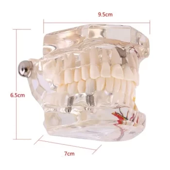 DD+ Education - Jaw Set With Implant - Image 3